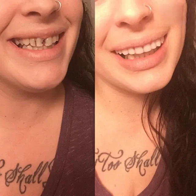 Perfect Smile Veneer (Upper & Lower)