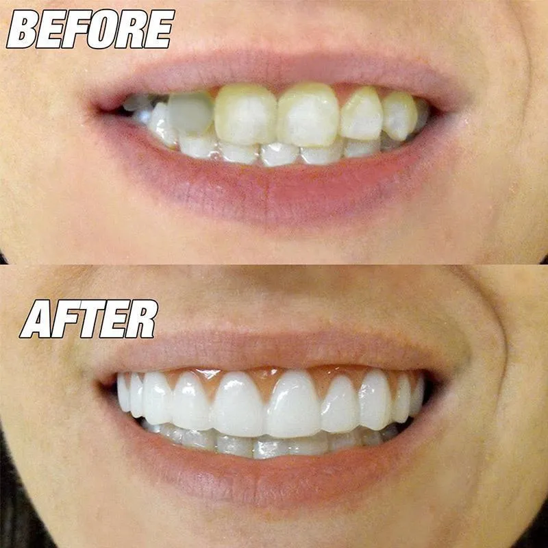 Perfect Smile Veneer (Upper & Lower)