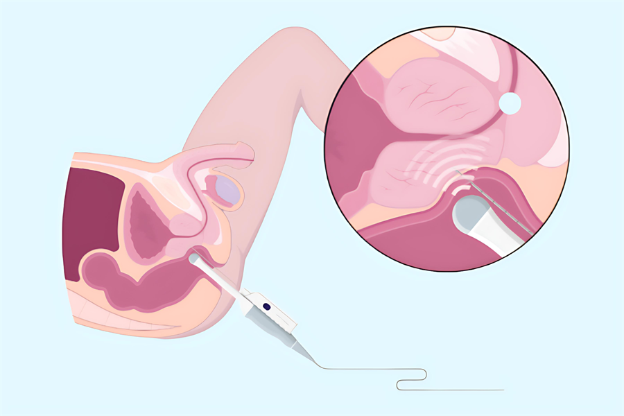 前立腺 肥大 治る