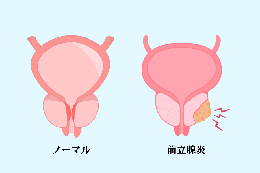 前立腺 症状