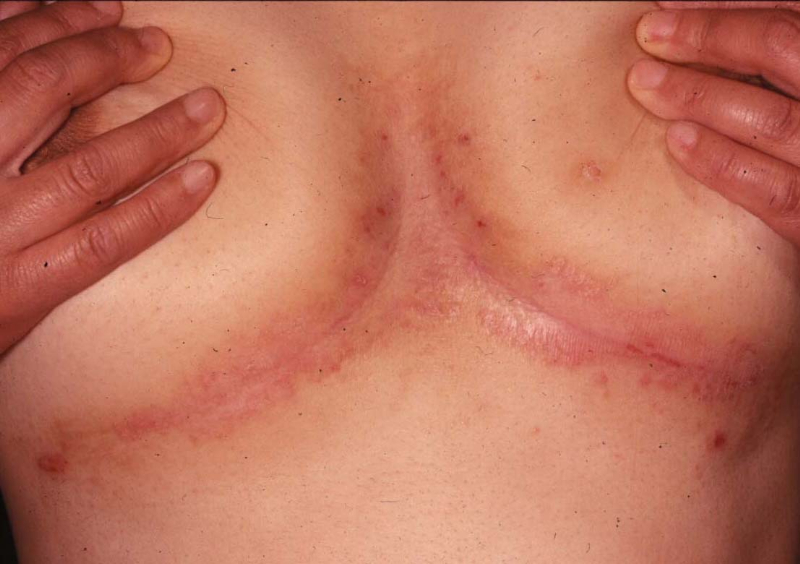 カンジダ（かんじだ）とは