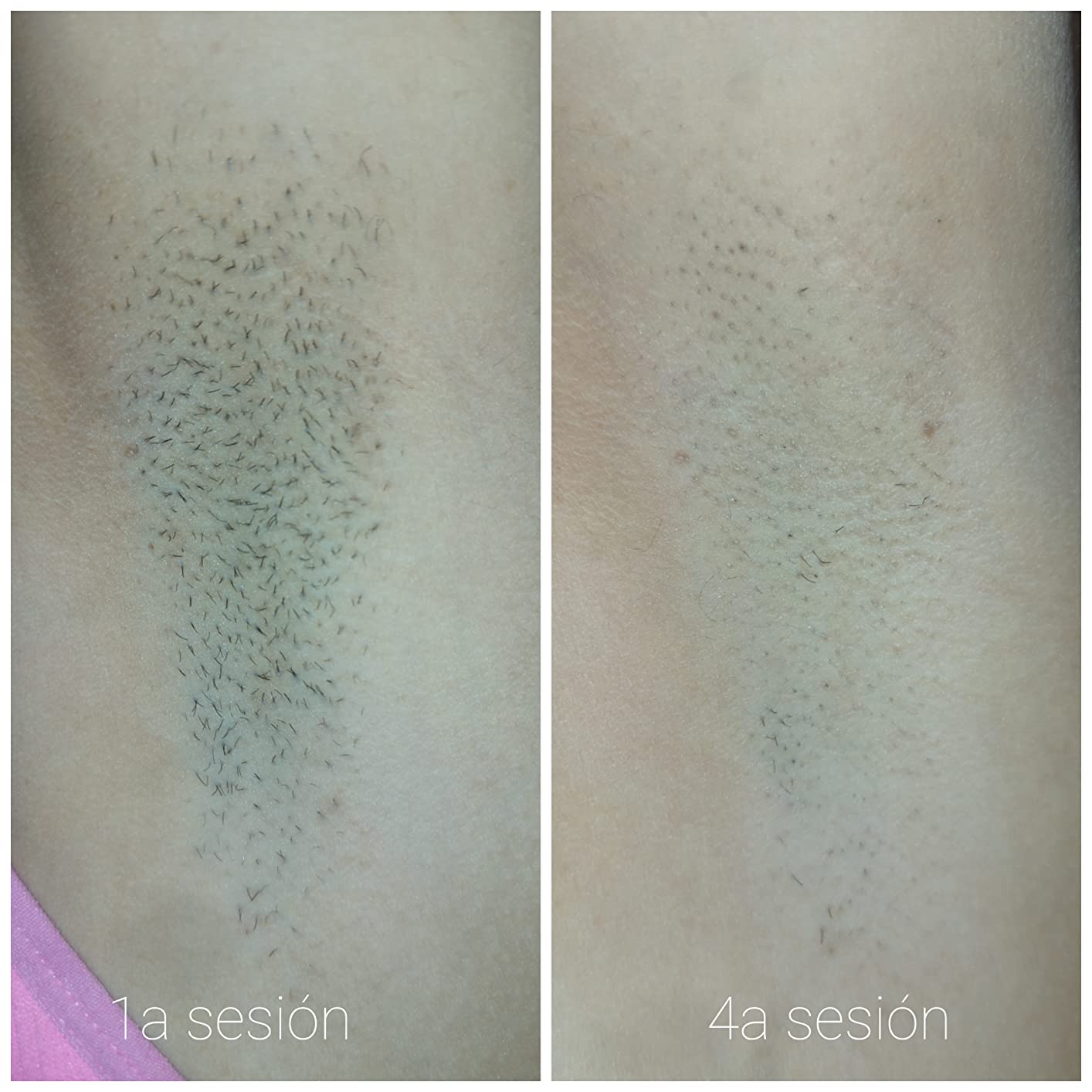 Philips Lumea 8000 Series IPL Painless Fast Hair Removal Device with SenseIQ Technology, 4 Attachments for Body, Face, Bikini and Underarms, Satin Compact Pen Trimmer, Model BRI949/00《NO8》